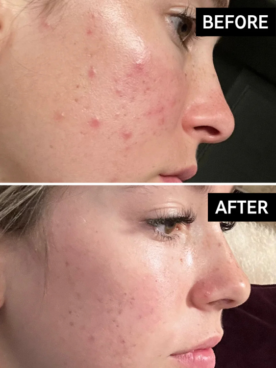 معالج البشره بحمض المانديليك اسد the inkey list mandelic acid treatment