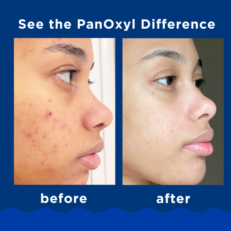 PanOxyl, Acne Foaming Wash Benzoyl Peroxide 10% Maximum Strength 