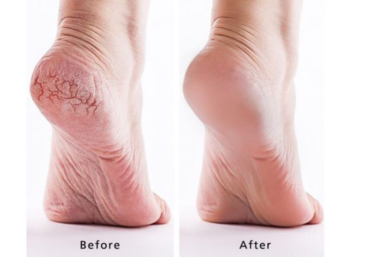 Mediheal, Paraffin Foot Mask EX 
