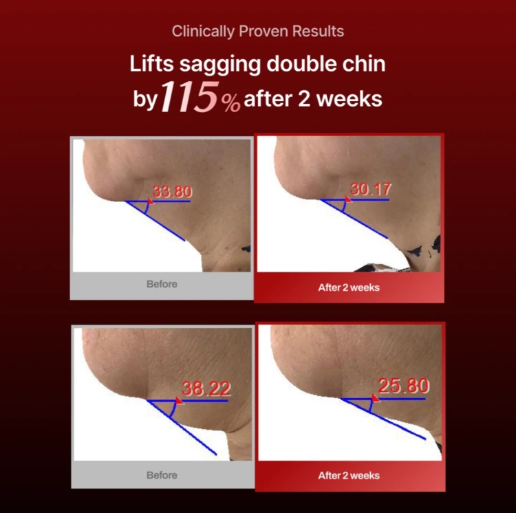 Meditherapy - Wrinkle-Fit Needle