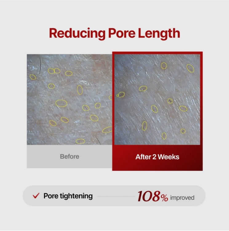 Meditherapy - Wrinkle-Fit Needle