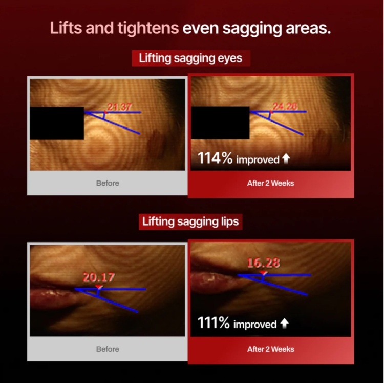 Meditherapy - Wrinkle-Fit Needle