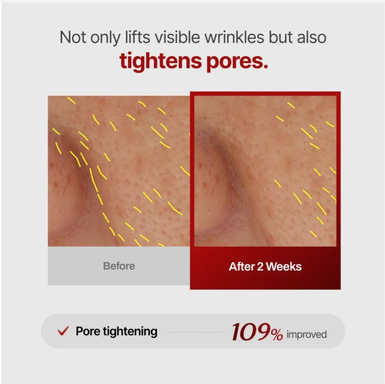 Meditherapy - Wrinkle-Fit Needle