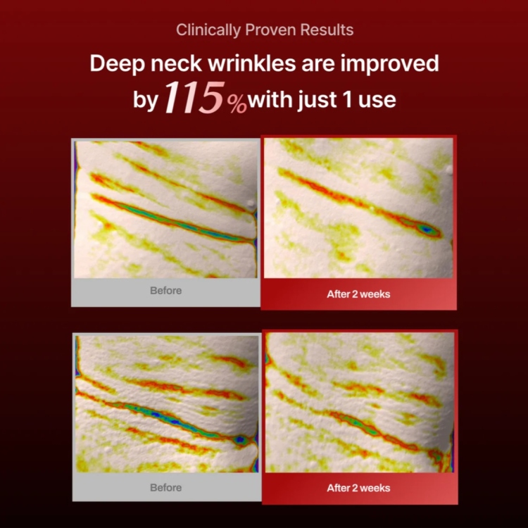 Meditherapy - Wrinkle-Fit Needle