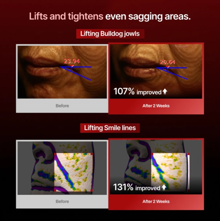 Meditherapy - Wrinkle-Fit Needle