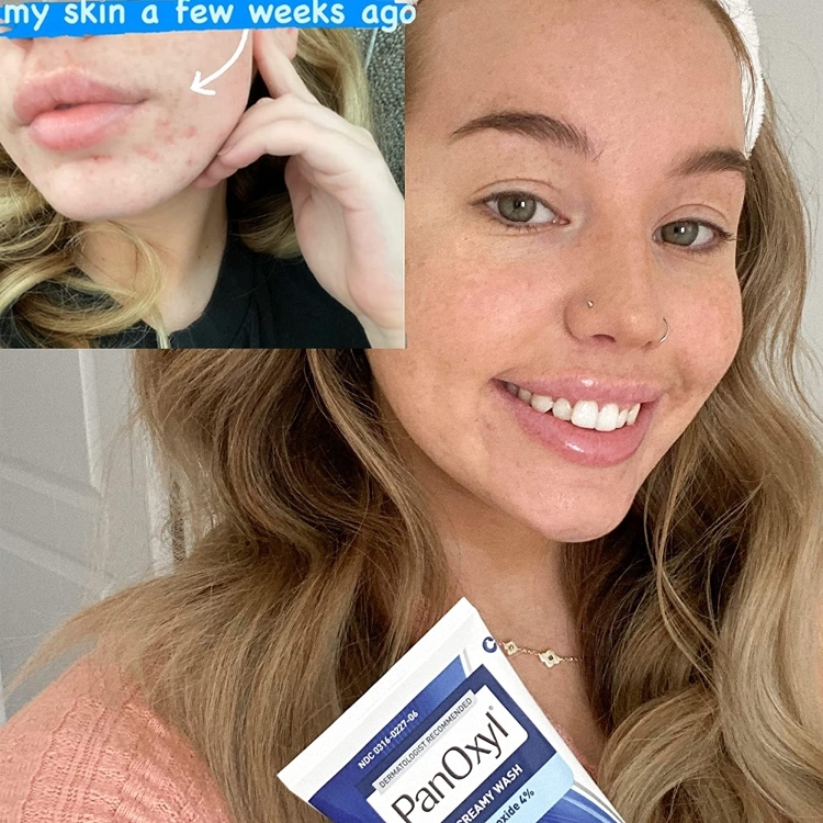 PanOxyl, Acne Creamy Wash Benzoyl Peroxide 4% Daily Control